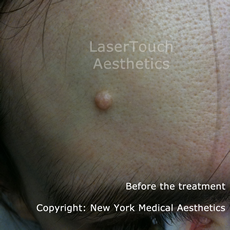 mole removal before white plains westchester